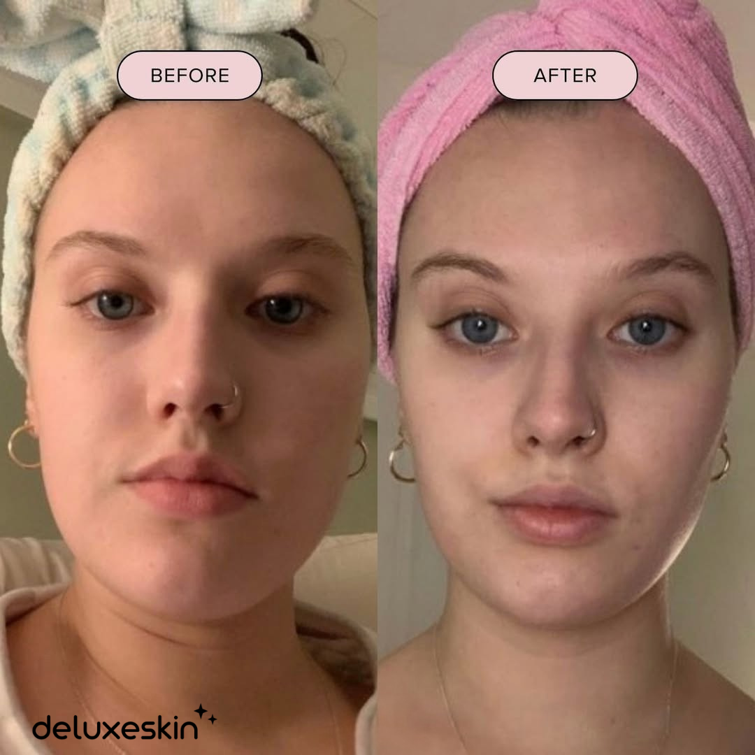 Ice Roller for Face & Eyes